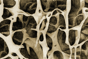 Osteoporotische Knochenstruktur
