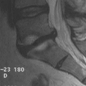 Bandscheibenverschleiss (Osteochondrose) an der Lendenwirbelsäule